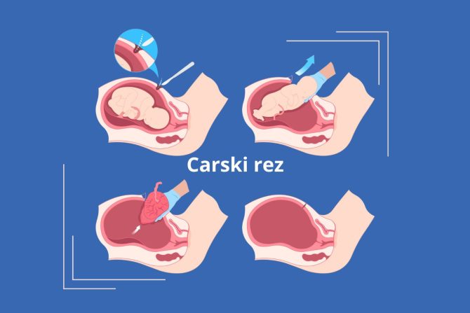 višestruki carski rez