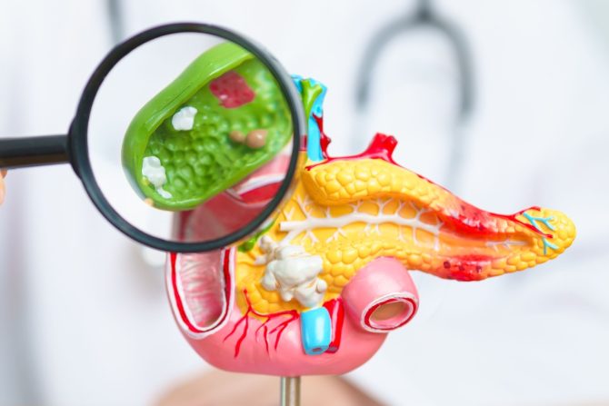 Primarni sklerozirajuci holangitis