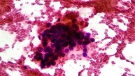 Zašto nastaje hepatocelularni karcinom, najčešći malignitet jetre i kako ga otkriti u što ranijem stadijumu