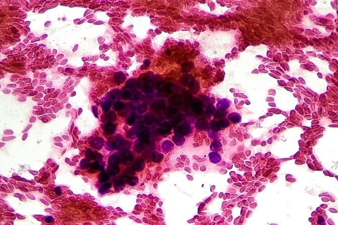 Hepatocecularni karcinom