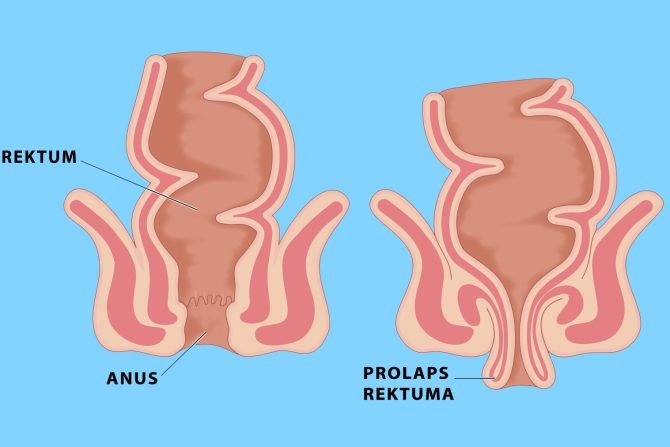 Prolaps rektuma