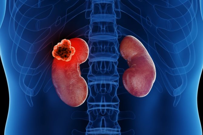 rak bubrega