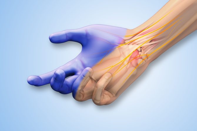 sindrom karpalnog tunela