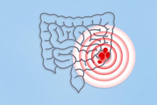 test za otkrivanje kolorektalnog karcinoma