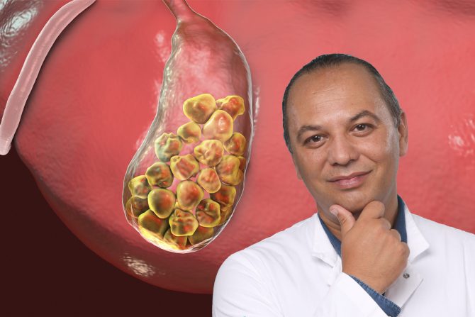 Kamen u žučnoj kesi Bokun