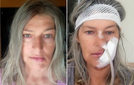 Fotografije i priču ne deli zbog aplauza, dovoljno je hrabra, već zbog pouka koje drugi mogu da izvuku iz njenog iskustva: Zorka Veličković pre i nakon operacije Foto: Zorka Veličković/privatna arhiva