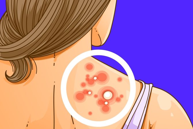 akne na ramenima i kućni lekovi