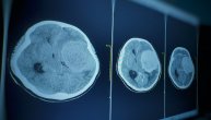 Meningiomi mogu da počnu da se razvijaju u detinjstvu i otkriju posle 30 godina