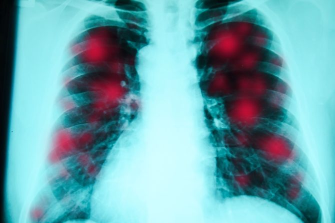 metastatski rak pluća