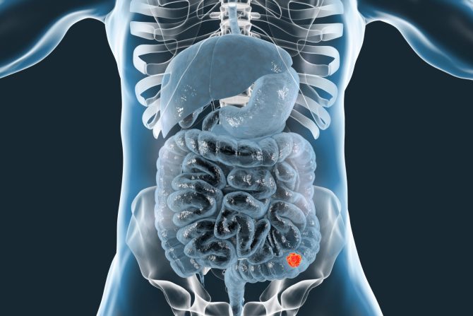 Rak debelog creva