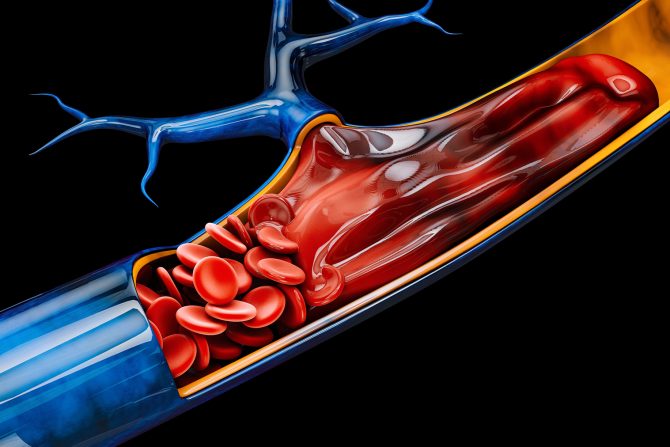 duboka venska tromboza