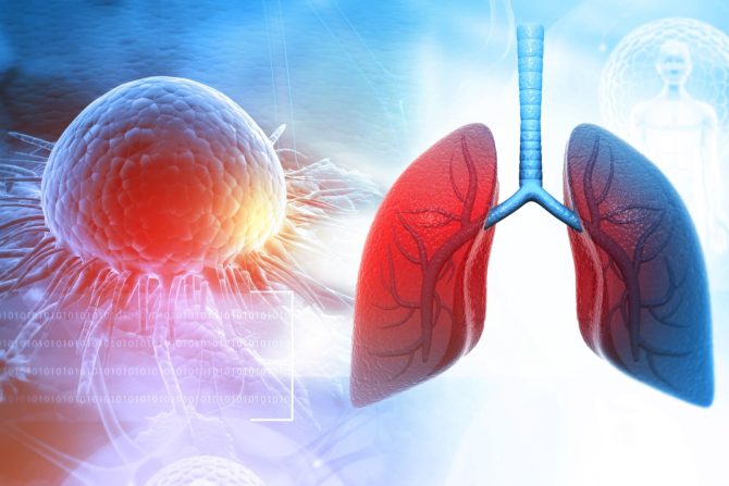 prva vakcina protiv raka pluća