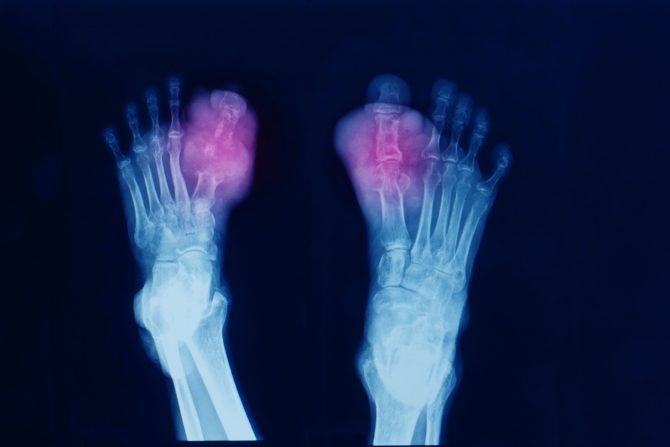 Visok nivo mokraćne kiseline