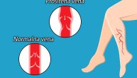 Proširene vene i bol u nogama uglavnom su rezultat jedne loše navike, upozoravaju vaskularni hirurzi