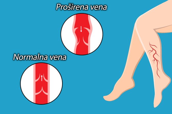 proširene vene
