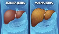 Ovo je prvi korak u lečenju masne jetre: Zanemarivanje bolesti može da dovede do ciroze, pa čak i do raka