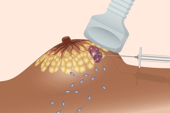 suplementi rak dojke