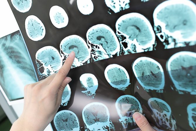 Multipla skleroza žene i muškarci