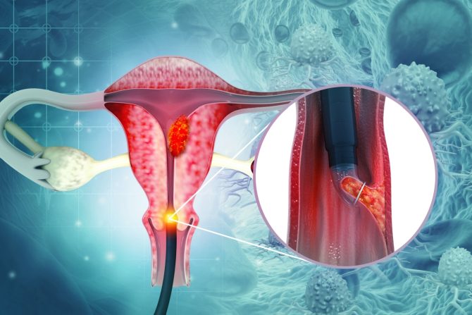 novi plan lečenja rak grlića materice