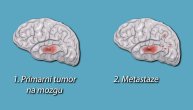 Ovih 5 karcinoma najčešće daju metastaze na mozgu