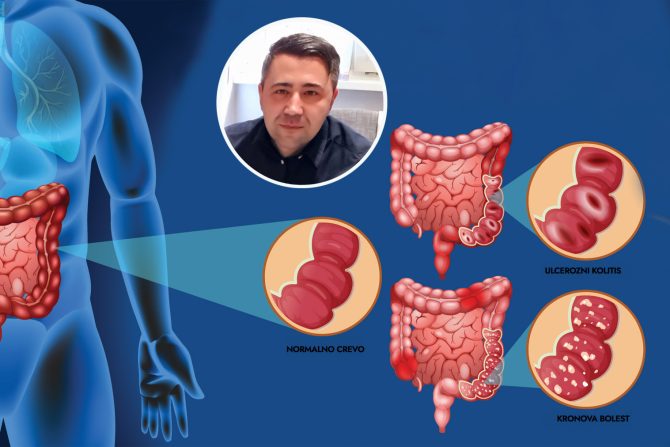 Zapaljenske bolesti creva Marković