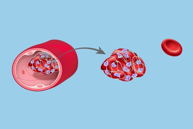 tihi ubica krvni ugrušak tromb