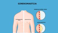Zašto dolazi do uvećanja grudi kod muškaraca i kako se ginekomastija leči