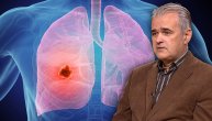 Imunološka terapija za rak pluća produžava život i štedi novac potreban za lečenje metastatskih karcinoma, kaže dr Zoran Andrić