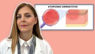 Kako se leči atopijski dermatitis i zašto se znaci razlikuju kod dece i kod odraslih, objašnjava prof. dr Mirjana Gajić Veljić
