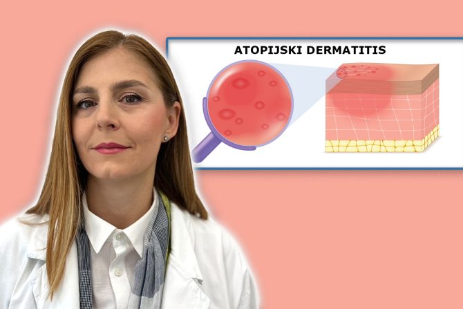 Atopijski dermatitis