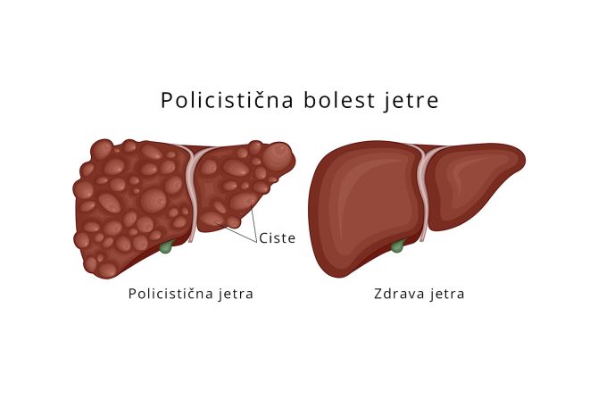 Policistična bolest jetre