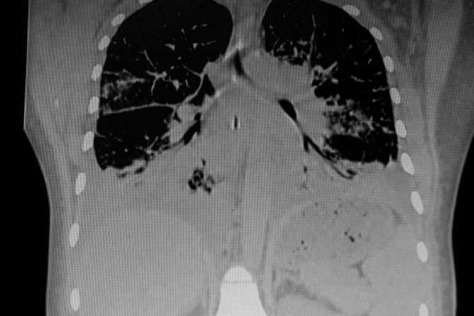limfangioleiomiomatoza (LAM)