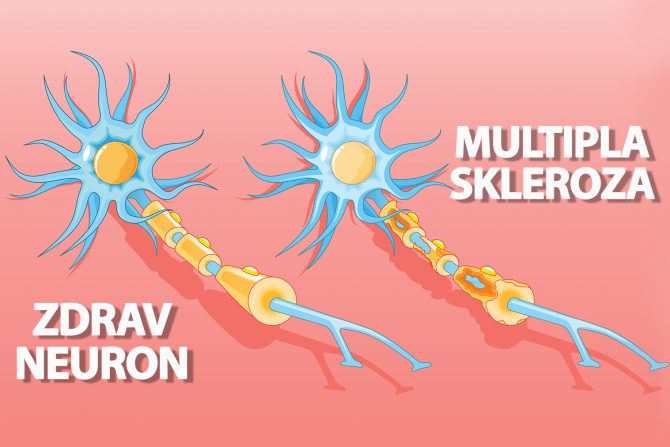 Multipla skleroza