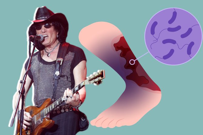 amputacija noge milić vukašinović