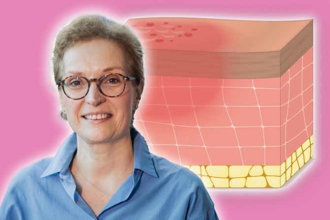 atopijski dermatitis