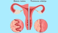 Najneprijatniji simptom menopauze o kome se uopšte ne govori: Sve o suvoći vagine i kako je rešiti
