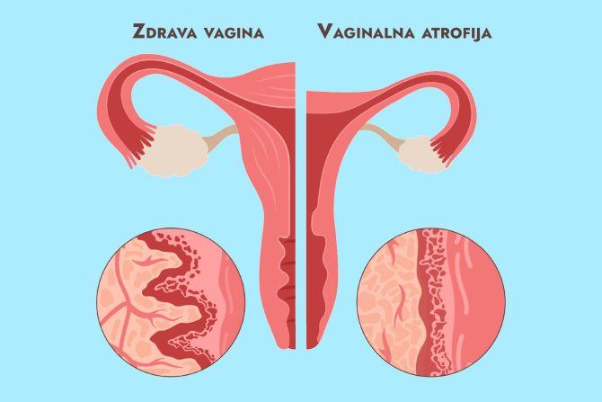 suvoća vagine