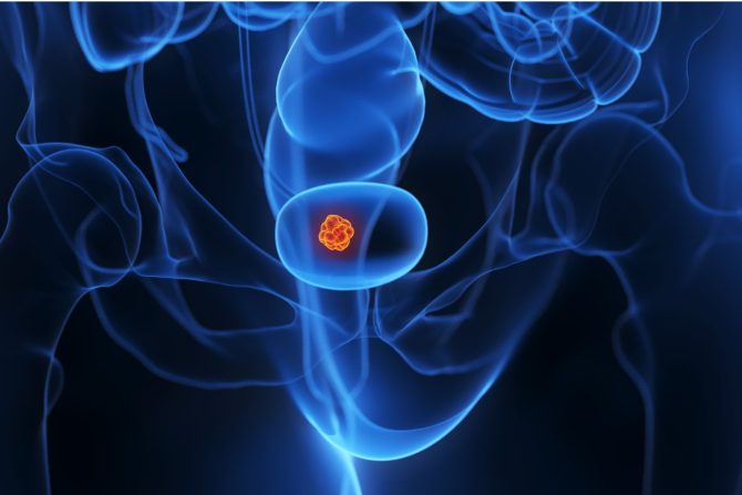 Rak mokraćne bešike