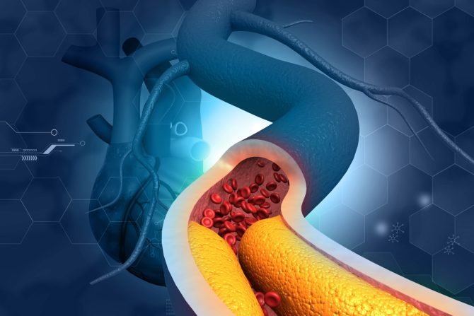 bolest koronarnih arterija