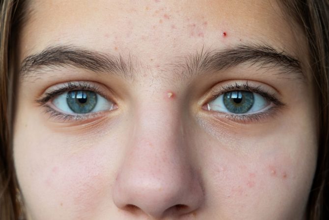 šećer i zdravlje kopže