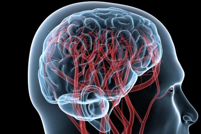 Vaskularna demencija