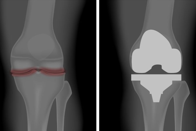 operacija zamene kolena