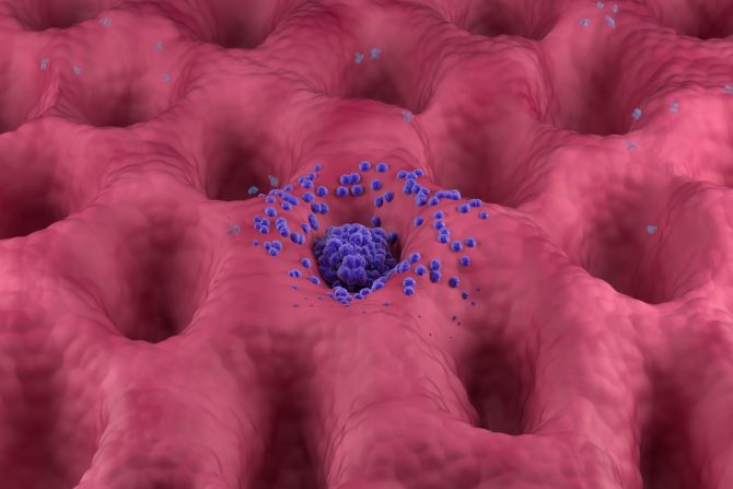 Rak trbušne maramice