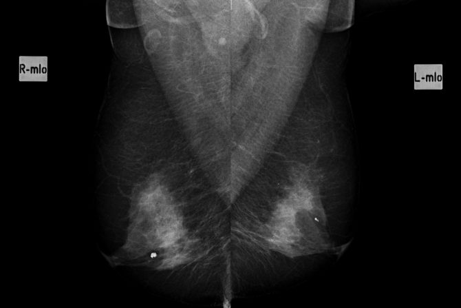 Kalcifikati u dojkama