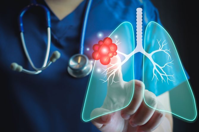 rak pluća