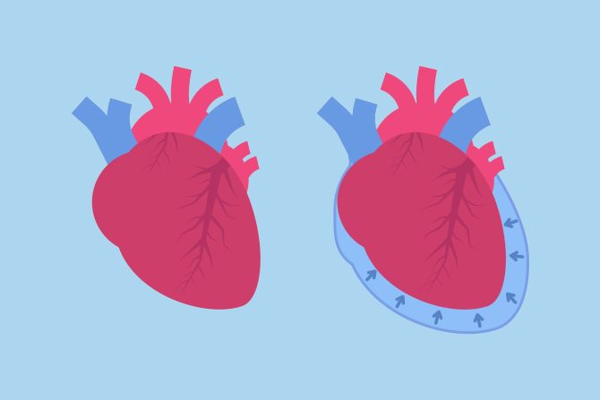 Nakupljanje tečnosti oko srca
