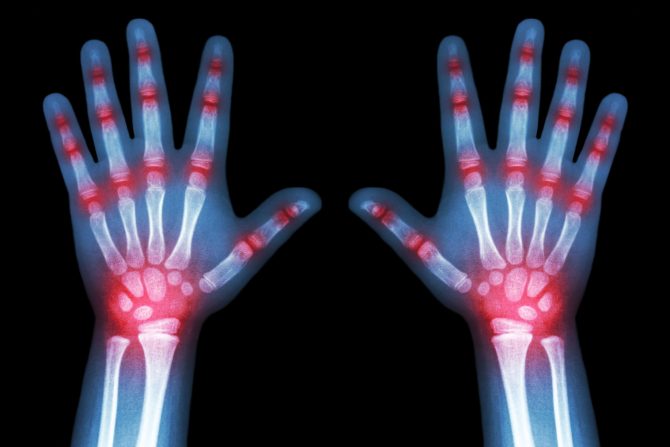 Reumatoidni artritis