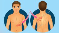 Gde se sve herpes zoster pojavljuje na telu i zašto nastaje ova virusna infekcija