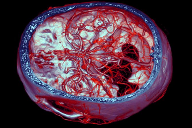 rizik od aneurizme mozga