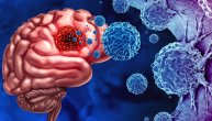 U koje doba dana su glavobolje zbog tumora na mozgu najjače: Ovi znaci se ne smeju zanemariti